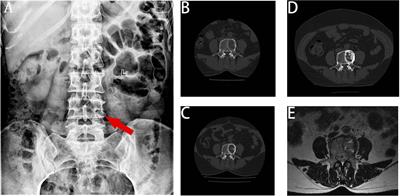 Denosumab combined with chemotherapy followed by anlotinib in the treatment of multiple metastases of malignant peripheral nerve sheath tumor: a case report and literature review
